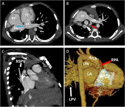 A case of rare pulmonary sequestration complicated with congenital heart disease treated by arterial embolization and atrial defect closure: A case report and review of literature